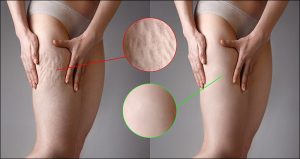 چگونه-سلولیت -را-از-بین-ببریم